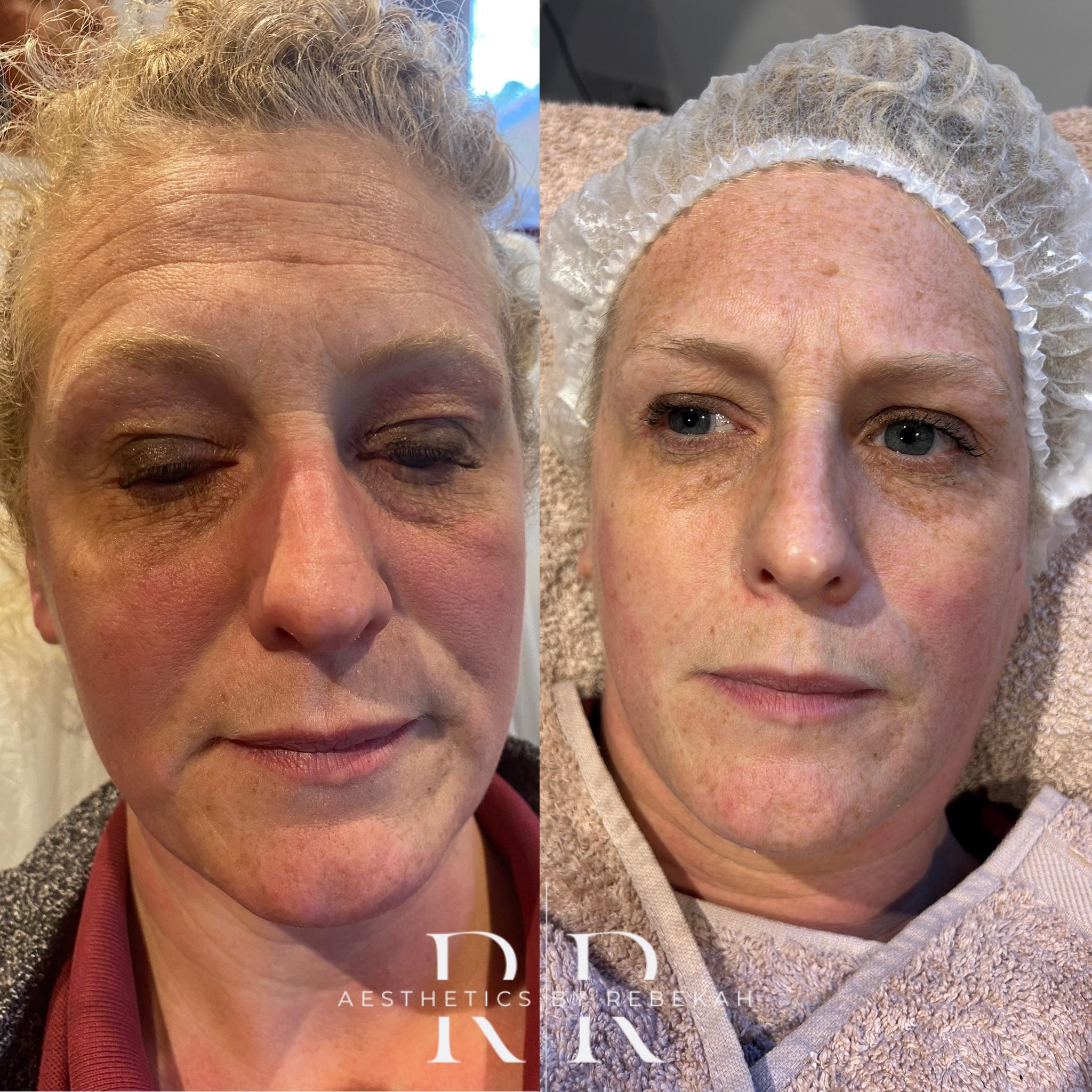 The Dual Injector Pro+